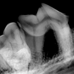 severe-bone-and-root-decay-150x150